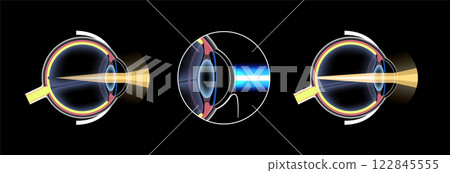 LASIK nearsightedness treatment LASIK nearsightedness treatment 122845555