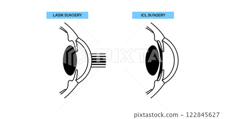 LASIK and ICL EVO 122845627