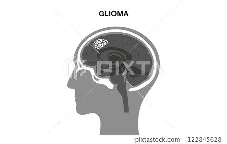 Glioma brain cancer Glioma brain cancer 122845628