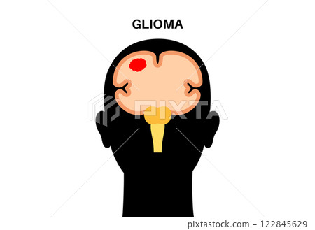 Glioma brain cancer Glioma brain cancer 122845629