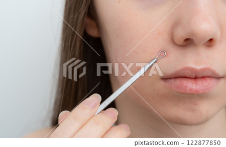 Close up young woman pointing to a pimple on a cheek with pimple removal tool. Comedones extractor. Inflamed acne and post-acne marks, redness. Hormonal acne treatment, puberty, adult acne, rosacea.  122877850
