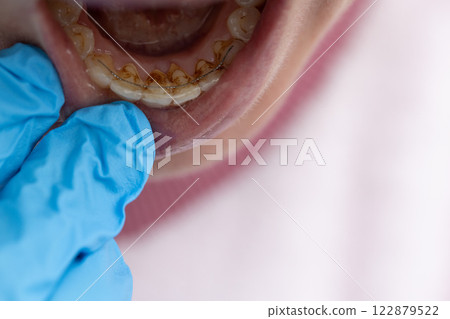 Dentist examining teeth with dental calculus and plaque where also fixed a retainer. Closeup. Dentist examining teeth with dental calculus and plaque where also fixed a retainer. Closeup. 122879522