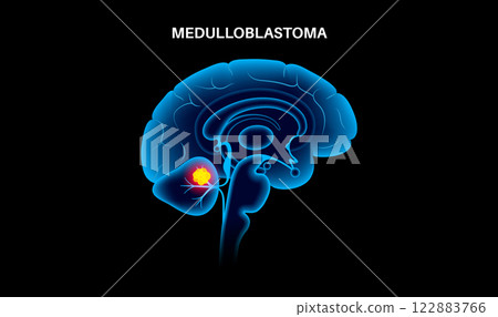 Medulloblastoma brain cancer Medulloblastoma brain cancer 122883766