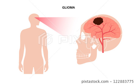 Glioma brain cancer 122883775