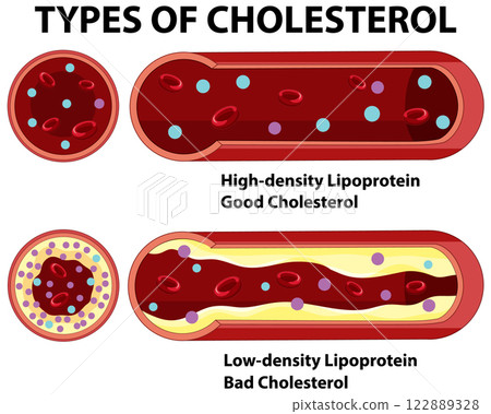 Understanding Types of Cholesterol 122889328