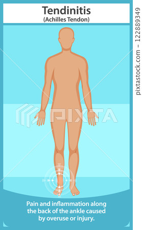 Achilles Tendonitis Illustration 122889349