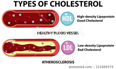 Understanding Cholesterol: HDL vs LDL Understanding Cholesterol: HDL vs LDL 122889374