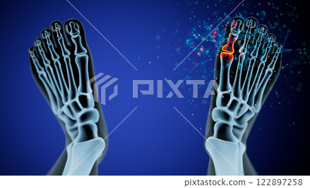 X-Ray Foot Analysis: Focus on Injured Toe in Left Foot X-Ray Foot Analysis: Focus on Injured Toe in Left Foot 122897258