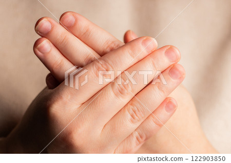 Woman showing her hands with bitten nails. Small nail plate. Poor manicure Woman showing her hands with bitten nails. Small nail plate. Poor manicure 122903850