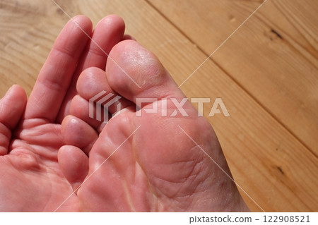 Chilblains on the soles of the feet of a woman in her 40s 122908521