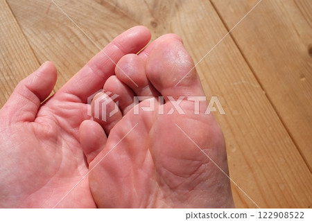 Chilblains on the soles of the feet of a woman in her 40s Chilblains on the soles of the feet of a woman in her 40s 122908522