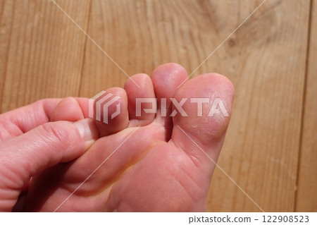 Chilblains on the soles of the feet of a woman in her 40s Chilblains on the soles of the feet of a woman in her 40s 122908523
