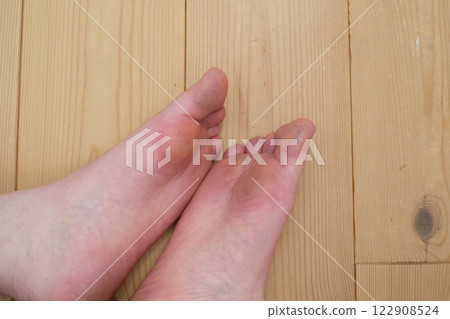 Chilblains on the soles of the feet of a woman in her 40s Chilblains on the soles of the feet of a woman in her 40s 122908524