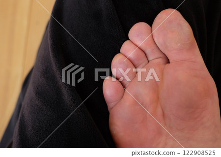 Chilblains on the soles of the feet of a woman in her 40s 122908525