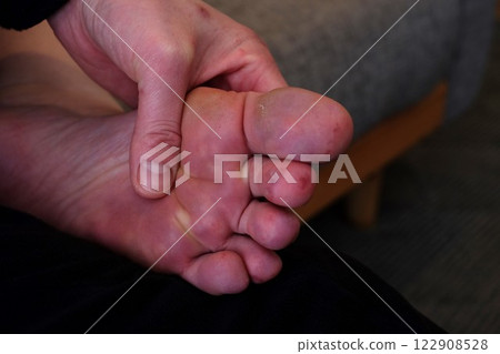 Chilblains on the soles of the feet of a woman in her 40s 122908528