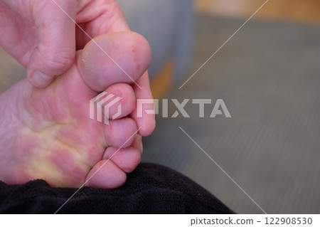 Chilblains on the soles of the feet of a woman in her 40s Chilblains on the soles of the feet of a woman in her 40s 122908530