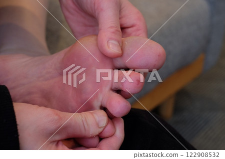 Chilblains on the soles of the feet of a woman in her 40s Chilblains on the soles of the feet of a woman in her 40s 122908532