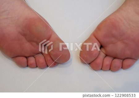 Chilblains on the soles of the feet of a woman in her 40s 122908533