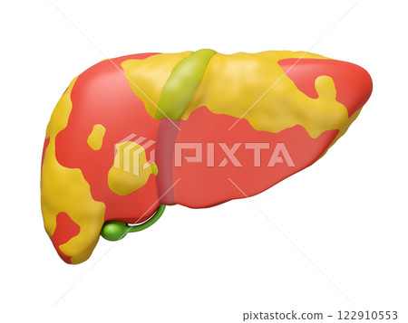 3d fatty liver disease isolated. 3d illustration render 122910553