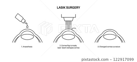 LASIK eye surgery 122917099