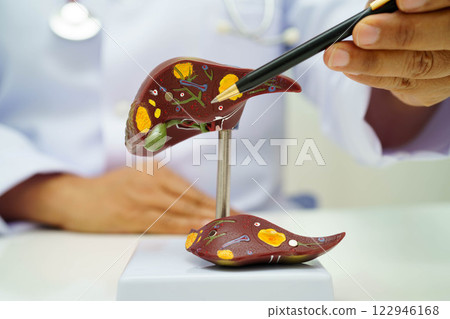 Cirrhosis, Liver cancer, fatty liver, Asian doctor with liver human anatomy model in World Hepatitis Day at hospital. Cirrhosis, Liver cancer, fatty liver, Asian doctor with liver human anatomy model in World Hepatitis Day at hospital. 122946168