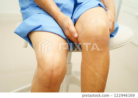 Asian elderly woman patient with scar knee replacement surgery in hospital. Asian elderly woman patient with scar knee replacement surgery in hospital. 122946169