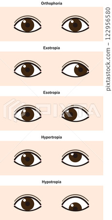 List of types of strabismus (Strabismus) List of types of strabismus (Strabismus) 122956580