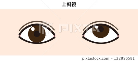 Illustration of upper strabismus 122956591