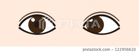 Illustration of Esotropia (Strabismus/Esotropia) Illustration of Esotropia (Strabismus/Esotropia) 122956610
