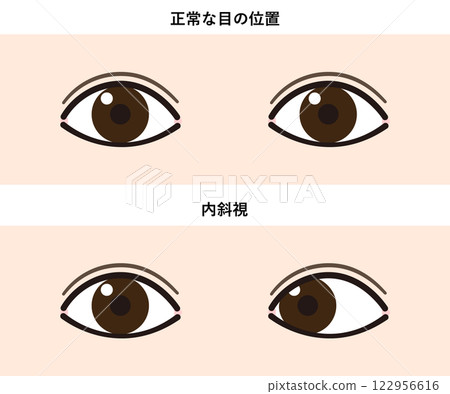 內斜視與正常眼睛的比較圖 122956616