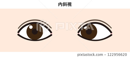 內斜視的插圖 內斜視的插圖 122956620