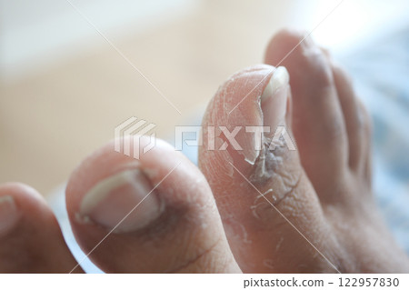 Care and condition of feet with cracked and dry skin 122957830