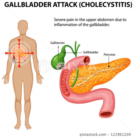 Understanding Gallbladder Attack and Cholecystitis Understanding Gallbladder Attack and Cholecystitis 122961209