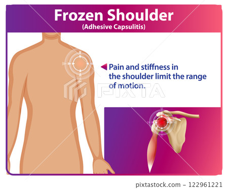 Understanding Frozen Shoulder Symptoms 122961221
