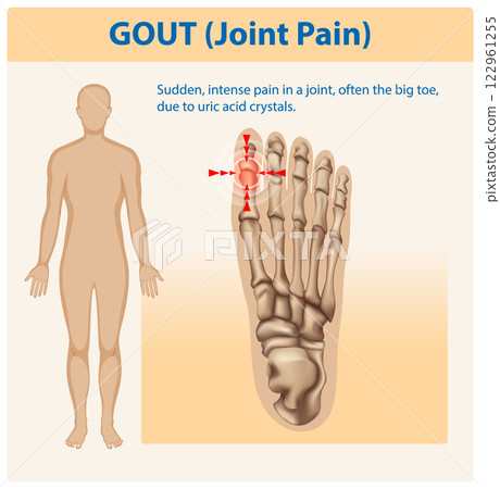 Understanding Gout and Joint Pain 122961255