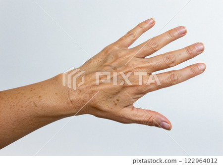 Frequent spots on the back of the hands 122964012