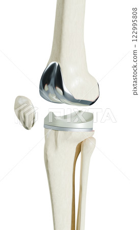 Total Knee Replacement is surgery to replace diseased or damaged joint surfaces of the knee with metal and plastic prosthetic devices. Total Knee Replacement is surgery to replace diseased or damaged joint surfaces of the knee with metal and plastic prosthetic devices. 122995808