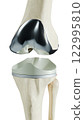 Total Knee Replacement is surgery to replace diseased or damaged joint surfaces of the knee with metal and plastic prosthetic devices. 122995810