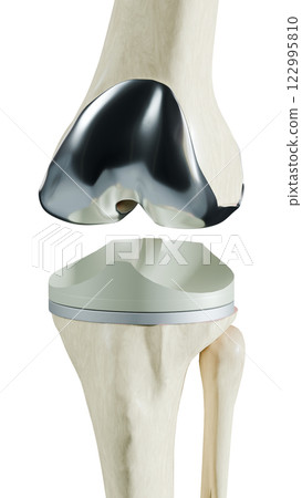 Total Knee Replacement is surgery to replace diseased or damaged joint surfaces of the knee with metal and plastic prosthetic devices. 122995810