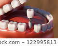 Dental implant screw, placement procedure 122995813