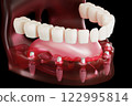 Dental implant screw, placement procedure 122995814