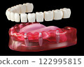 Dental implant screw, placement procedure 122995815