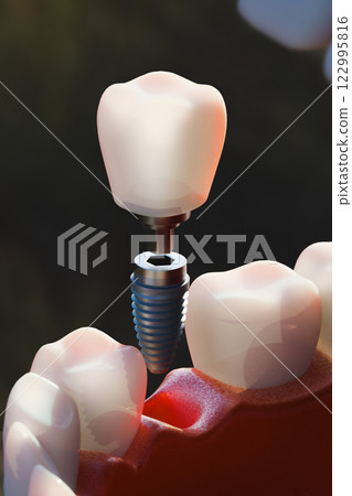 Dental implant screw, placement procedure Dental implant screw, placement procedure 122995816