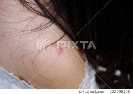 Close up BCG vaccination scars awaken an abscess on shoulder of Asian woman. Bacillus Calmette Gurin vaccine 122996198