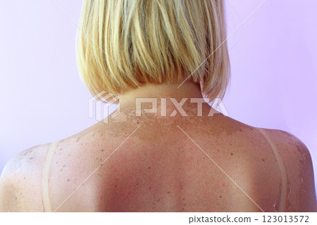 Sunburn from beach sun light on shoulder and back of caucacian girl. Body care Sunburn from beach sun light on shoulder and back of caucacian girl. Body care 123013572