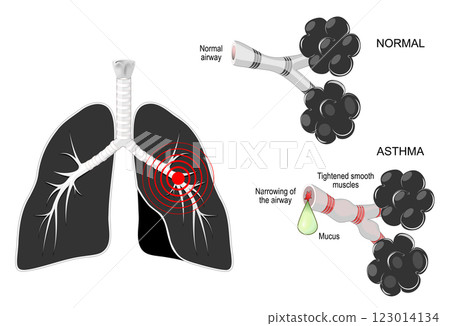 Asthma. Respiratory disease. Black lungs with red mark, and bronchi on white background 123014134