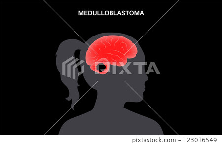 Medulloblastoma brain cancer Medulloblastoma brain cancer 123016549