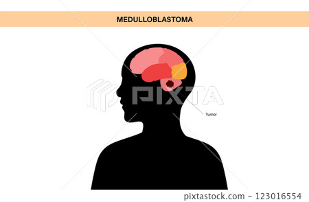 Medulloblastoma brain cancer Medulloblastoma brain cancer 123016554