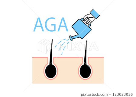 AGA 治療的插圖：一個人用噴壺將生髮劑塗抹在頭髮上 123023036