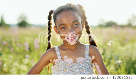 Young african girl with vitiligo smiling in a summer field of wildflowers 123025583